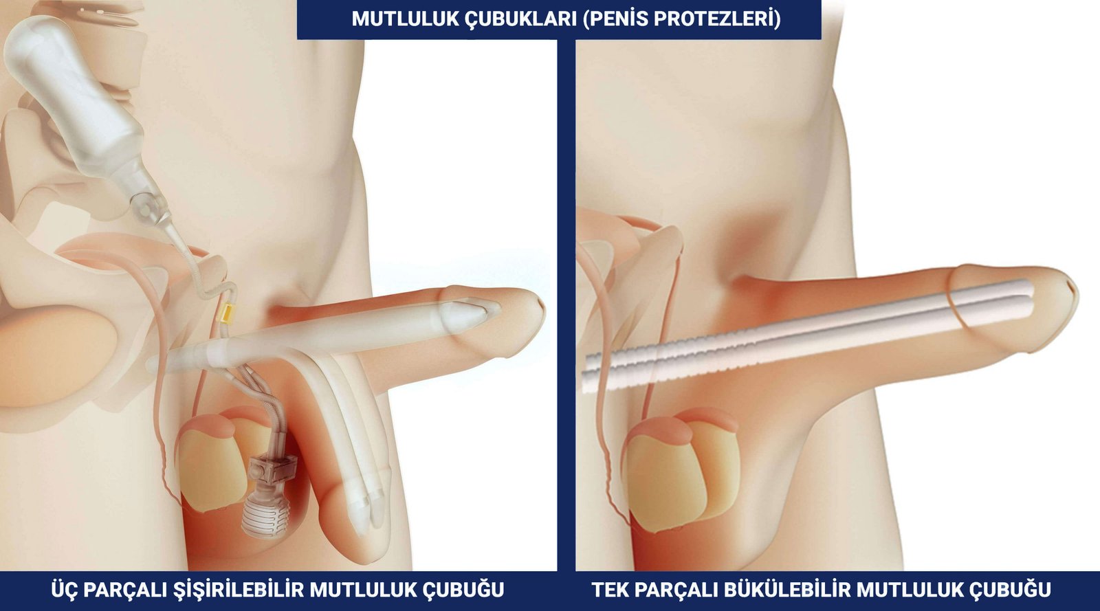 Op. Dr. Erdem Özbek | Üroloji Uzmanı | Penis büyütme